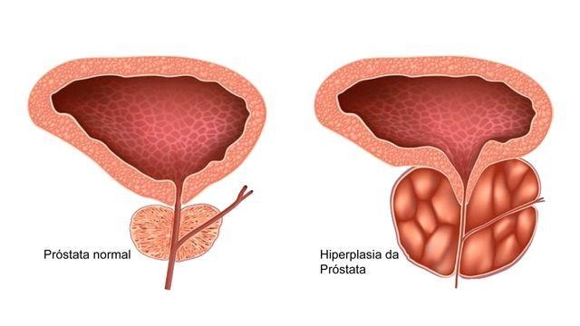 Existe tratamento para a Hiperplasia Prostática Benigna?
