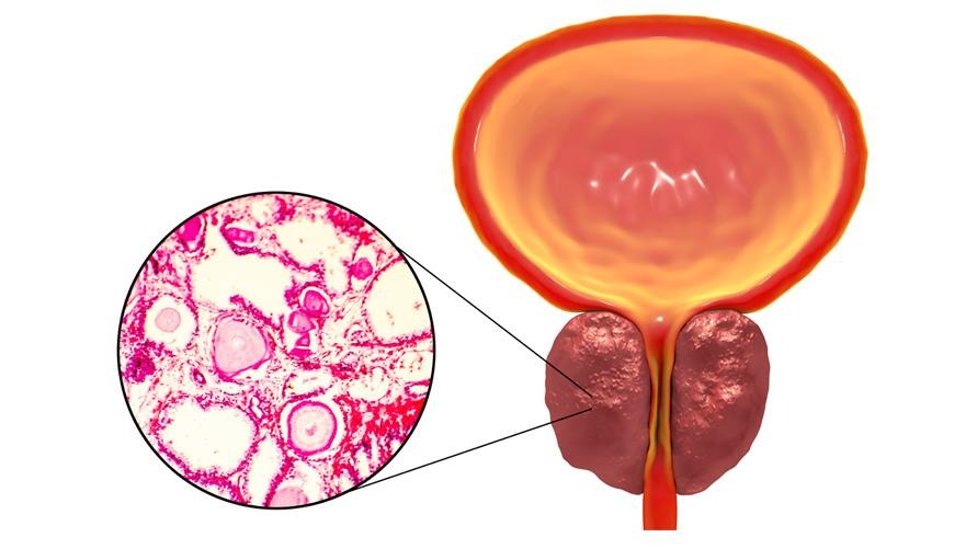 Quando a cirurgia deve ser indicada pra tratar hiperplasia prostática benigna (HPB)? - UROBH - Urologia Minimamente Invasiva